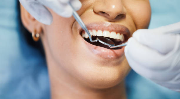 Best Emergency Wisdom Teeth Removal in Bellaire, TX